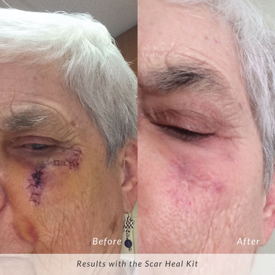 Before and after result