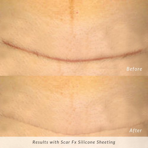 Before and after result